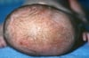 Seborrheic Dermatitis (Cradle Cap)