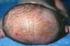 Dermatitis seborreica (costra láctea)
