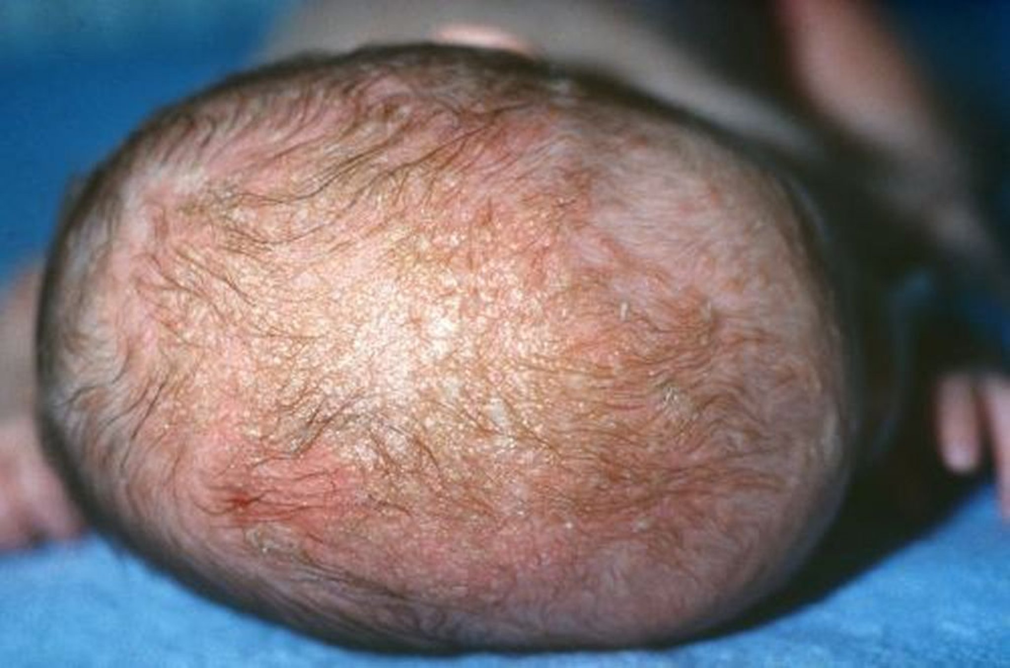 Milchschorf (seborrhoische Dermatitis)
