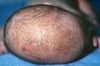Crosta láctea (dermatite seborreica)