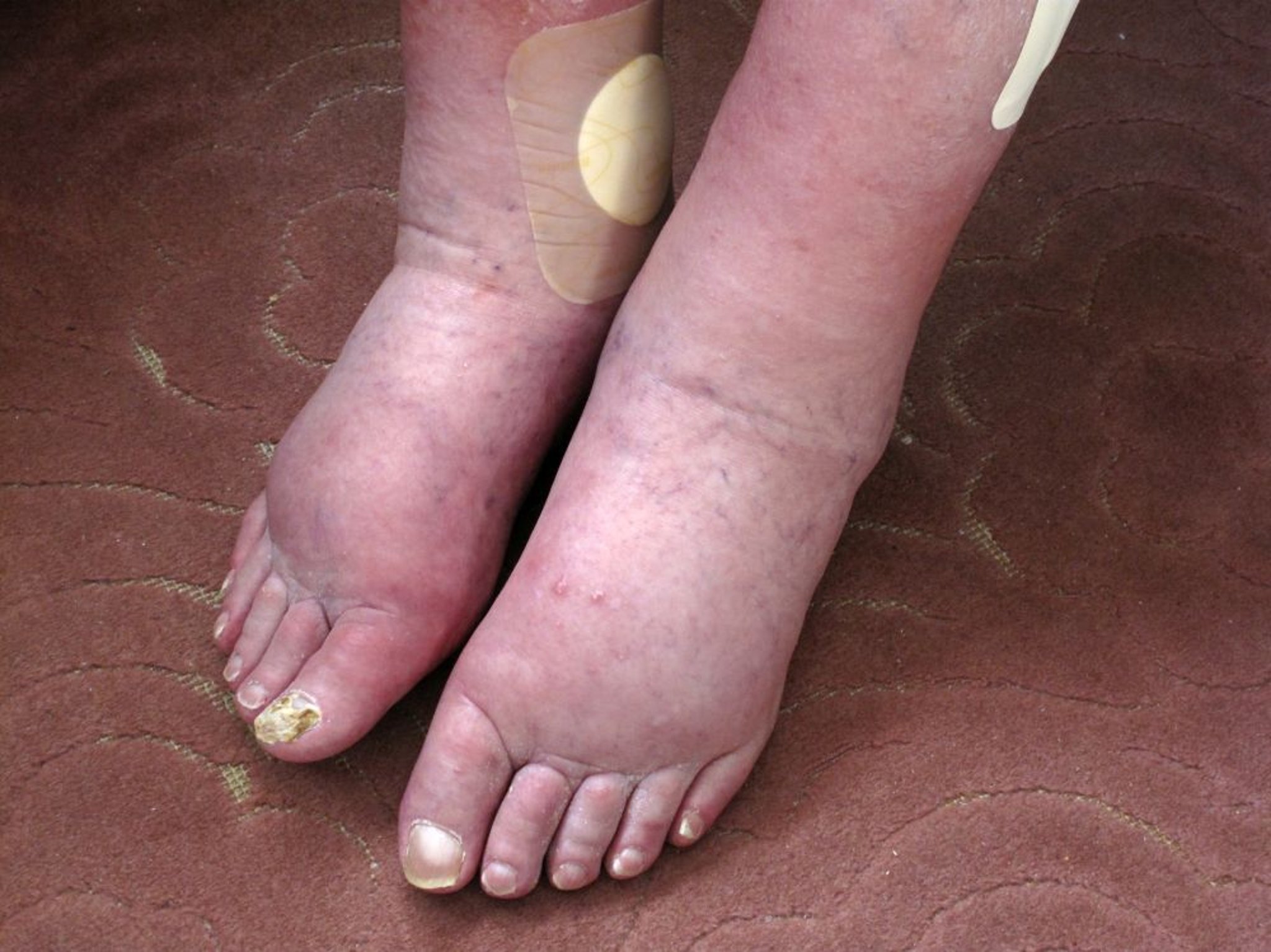 Hinchazón de la pierna (edema)