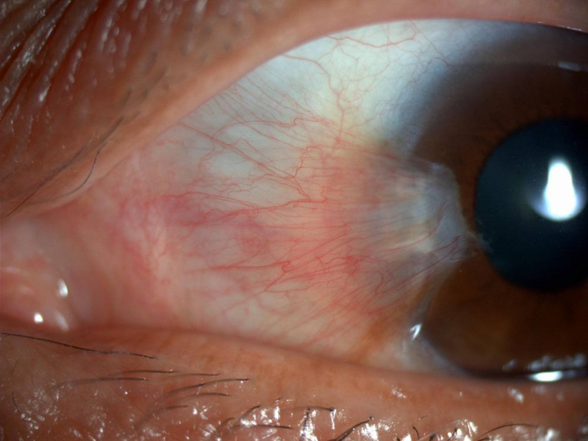 Pterygium