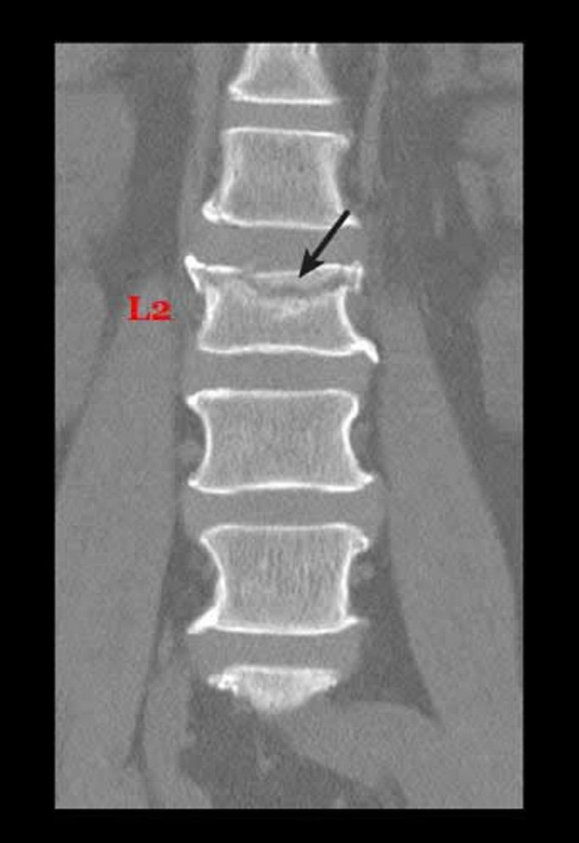 Compression Fracture Due to Osteoporosis