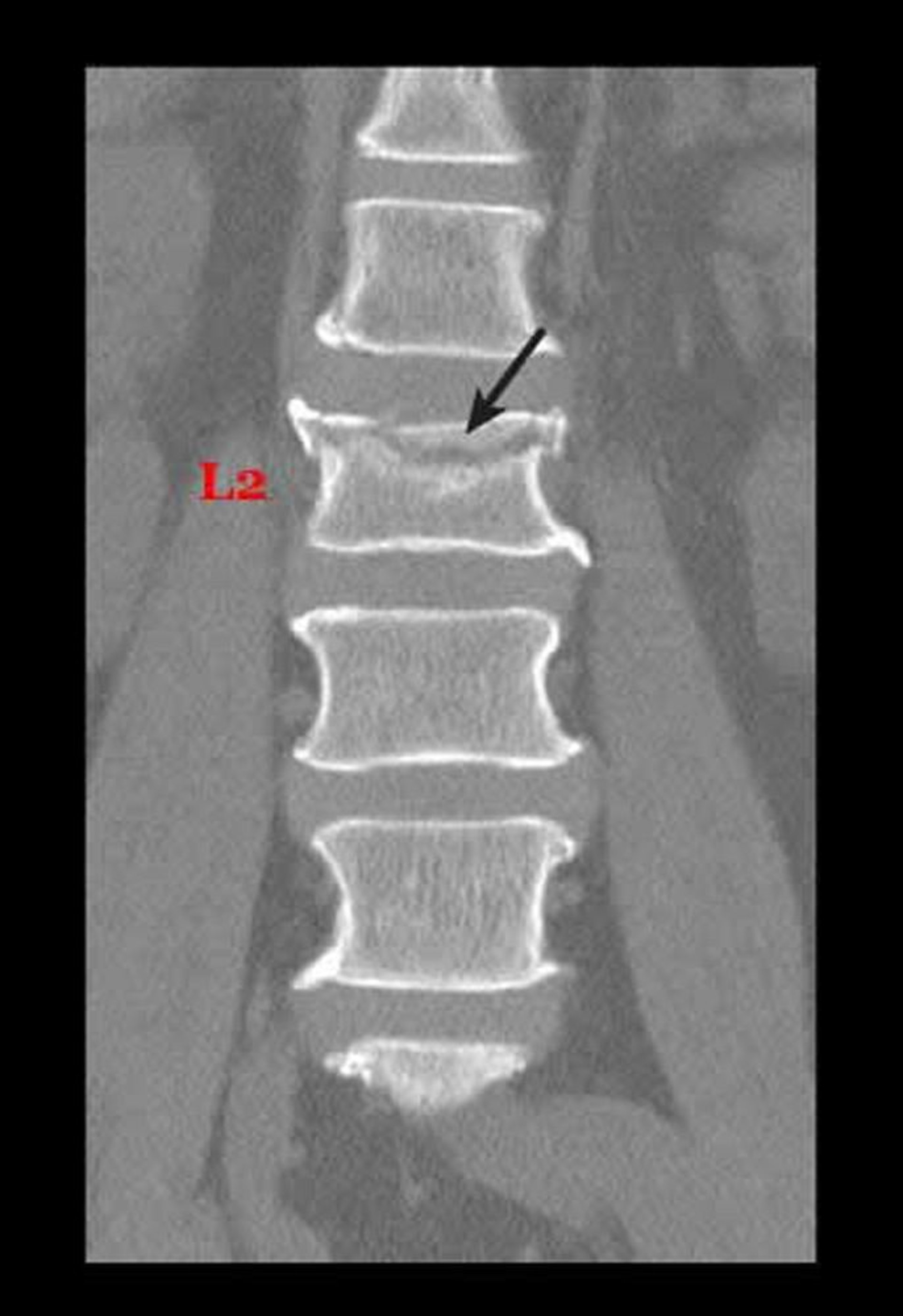 Fractura por compresión debida a osteoporosis