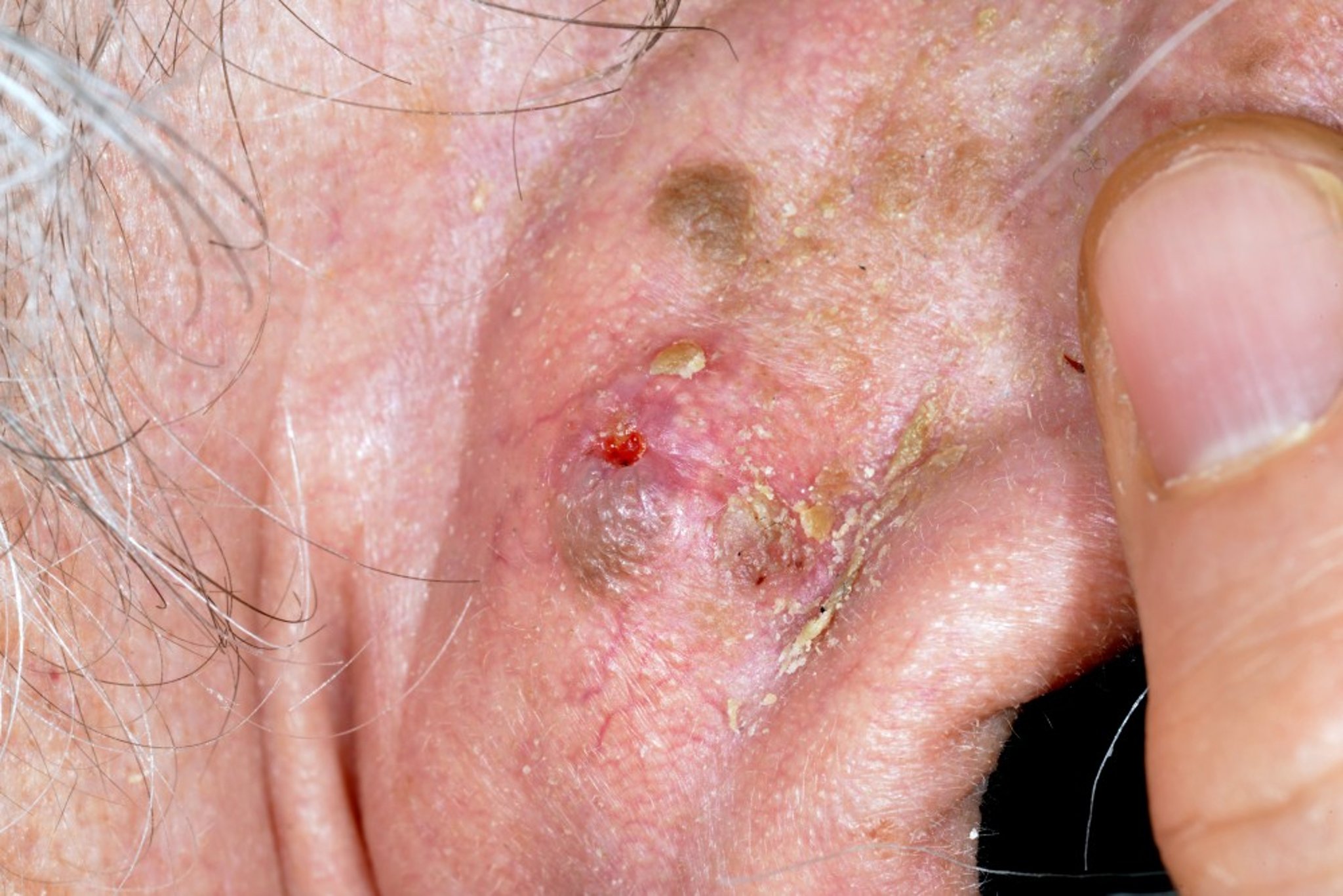 Squamous Cell Carcinoma (Earlobe)