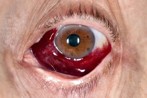 Hemorragia subconjuntival