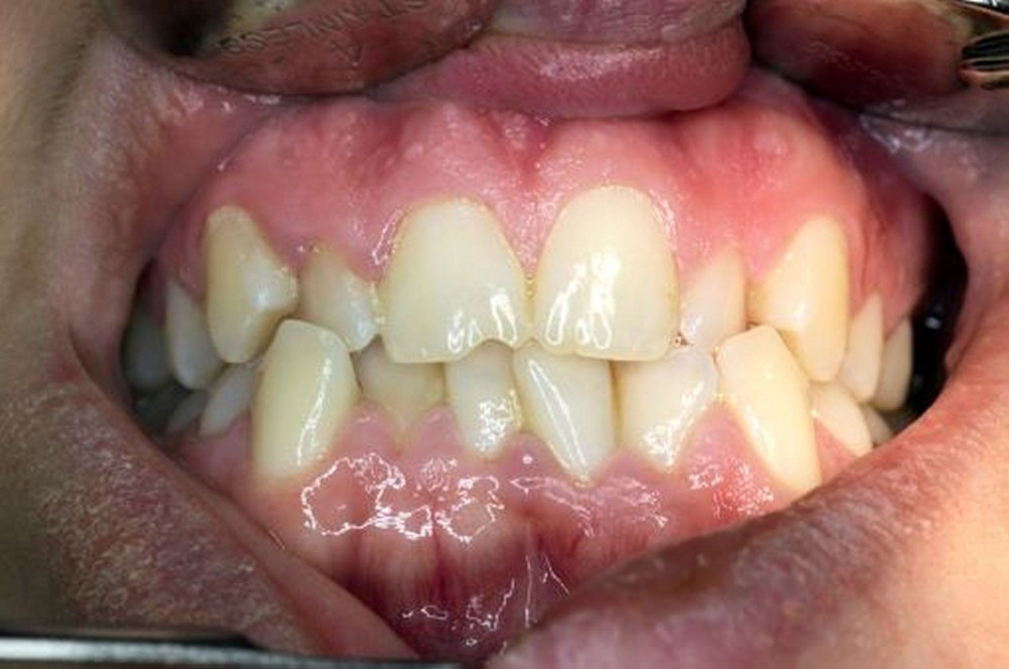 Malocclusion