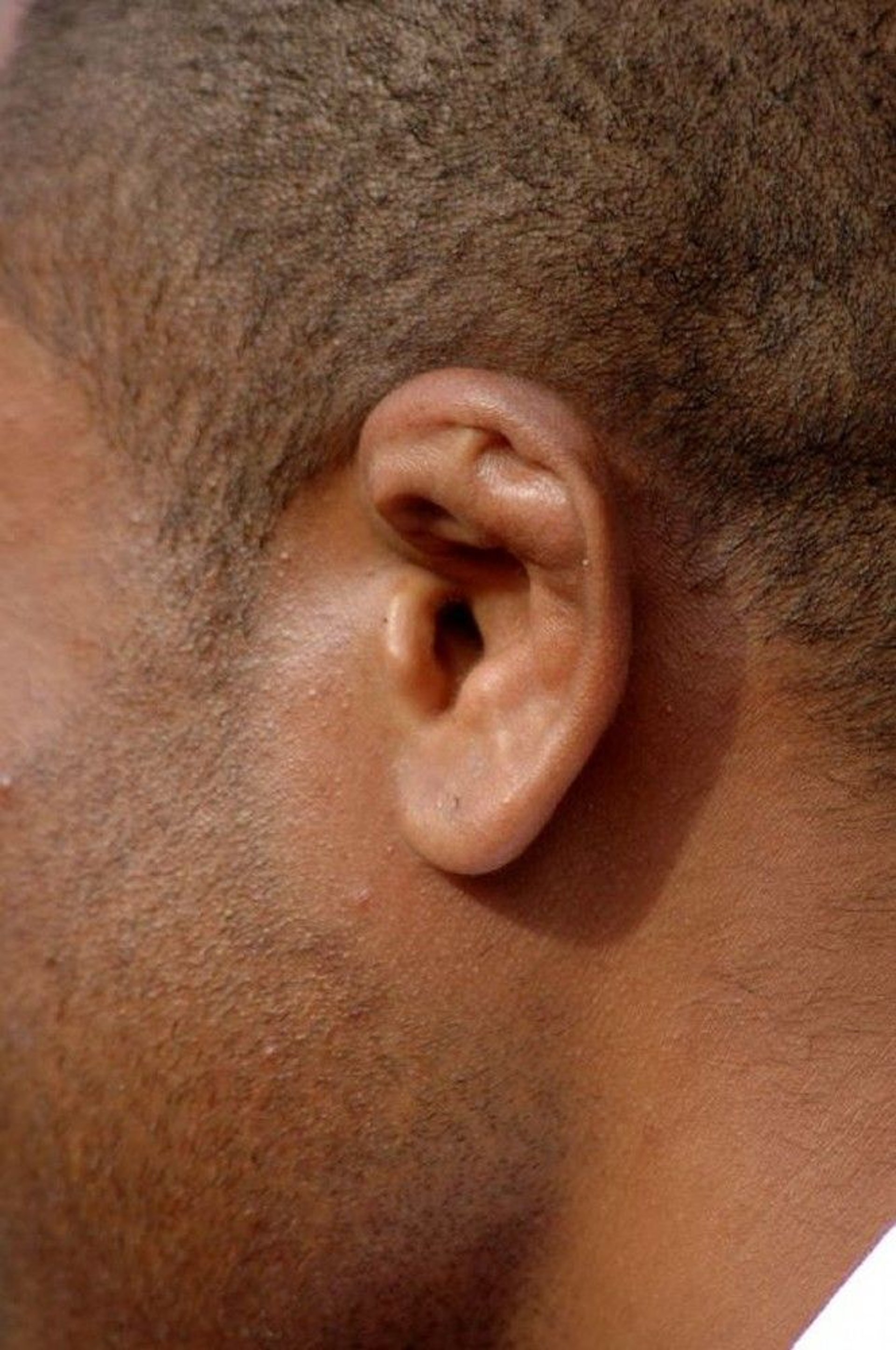 Cauliflower Ear