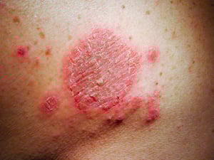 Dermatitis numular