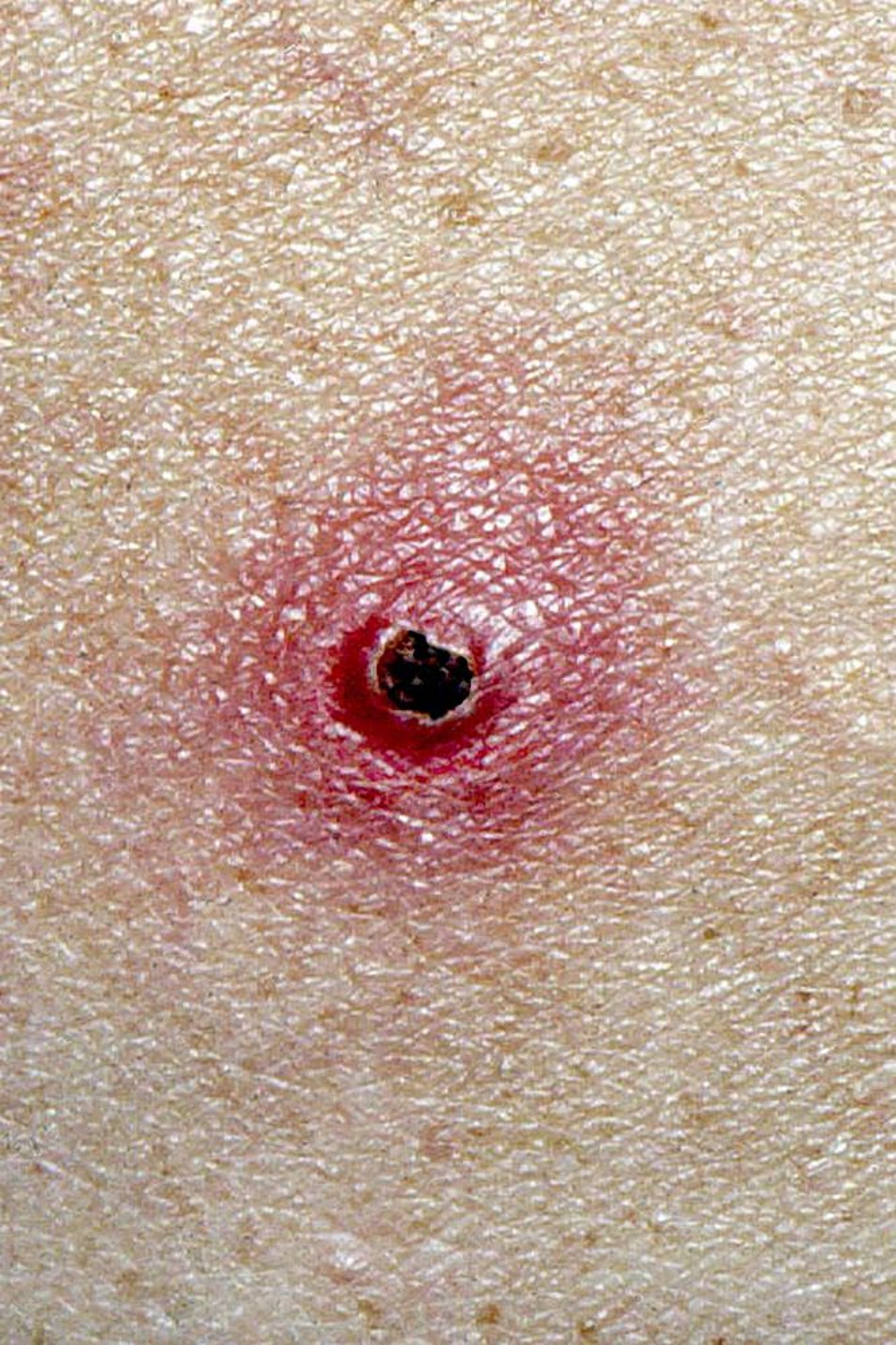 داء خَدْش القطة Cat-Scratch Disease