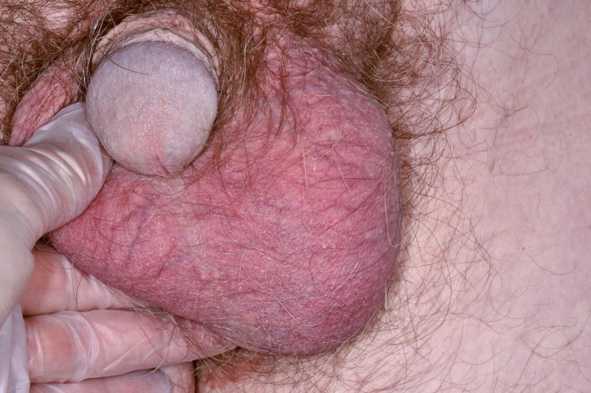 سَرطانُ الخُصيَة Testicular Cancer