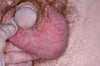Cancer du testicule