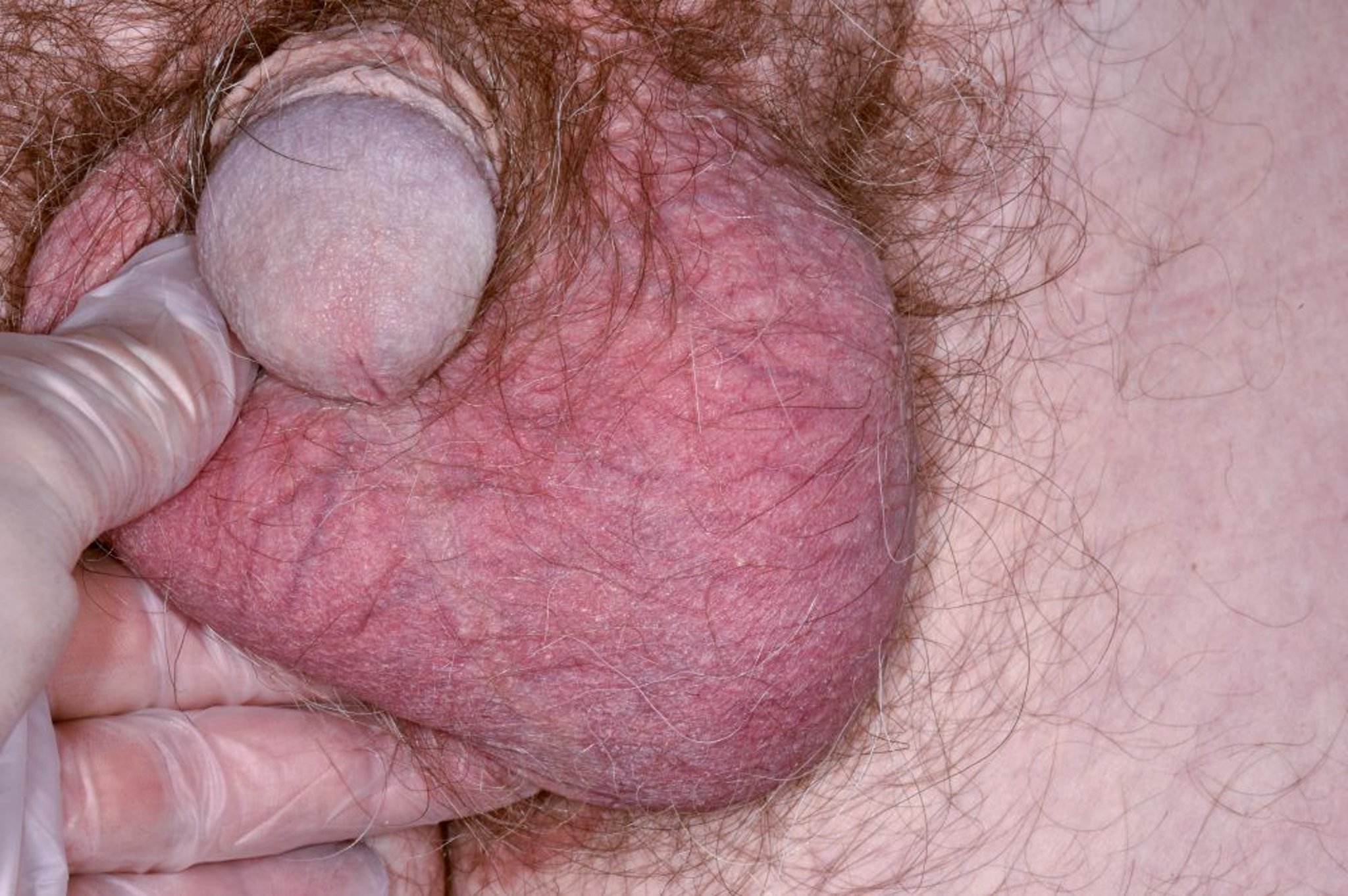Câncer testicular