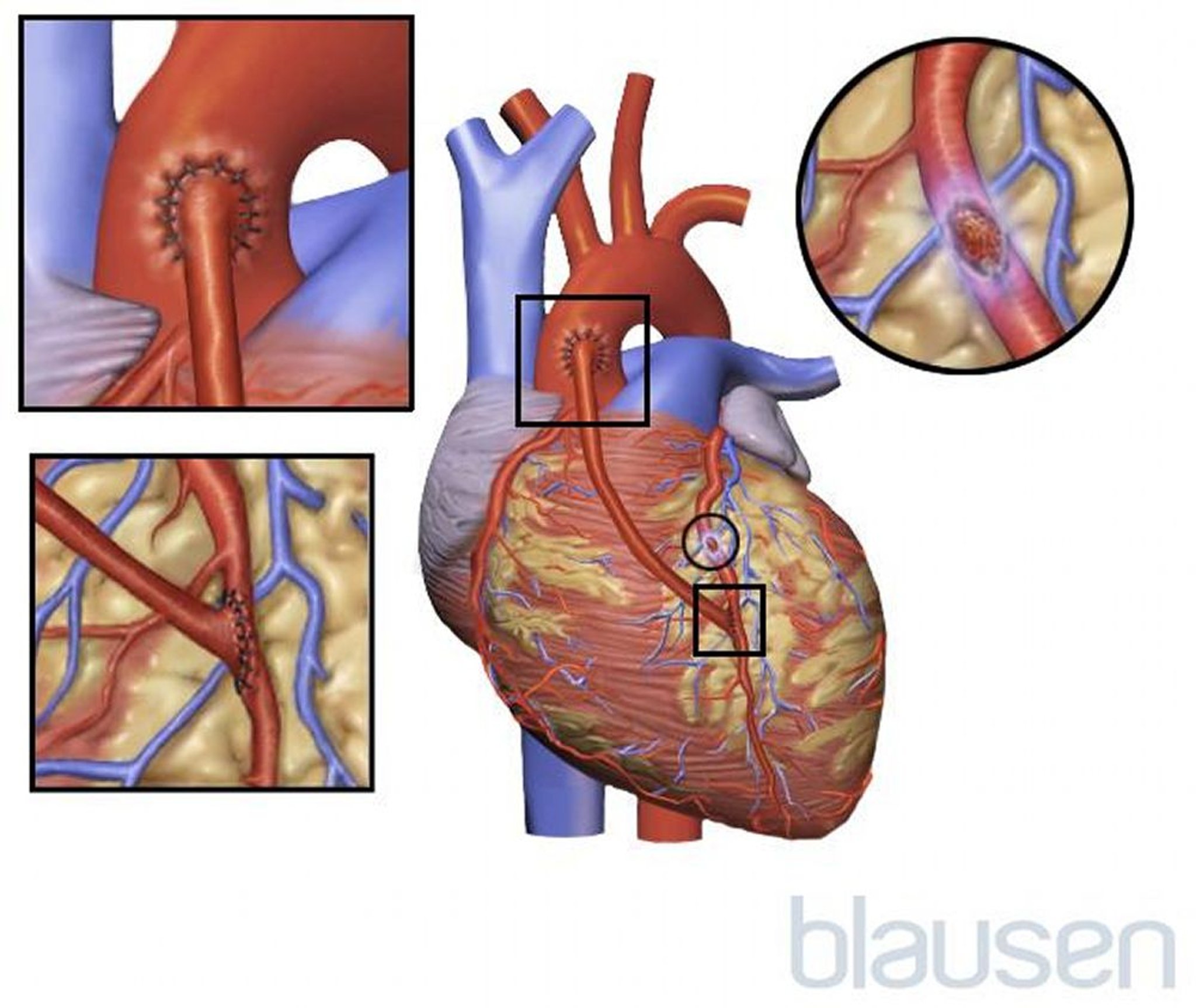 Koronararterienbypass-Operation (CABG)
