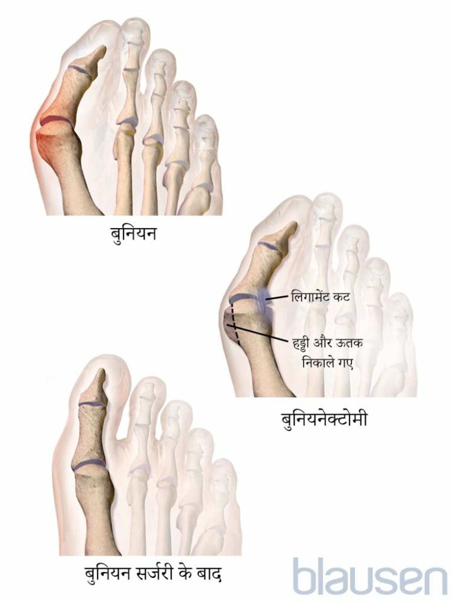 करोनरी धमनी बायपास ग्राफ्टिंग (CABG)