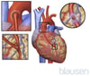 冠動脈バイパス術（CABG）