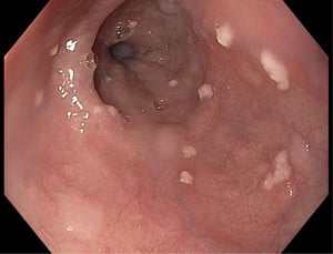 Infection de l’œsophage causée par un Candida