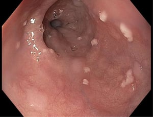 Candidiasis del esófago