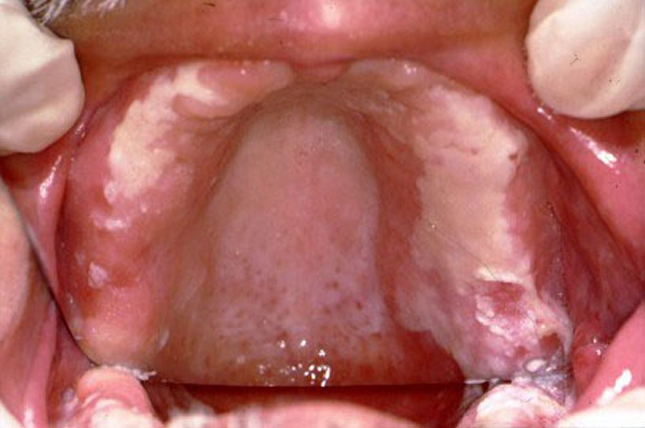 Durch <i >Candida</i> verursachte Mundhöhlenentzündung