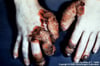 Chronic Mucocutaneous Candidiasis