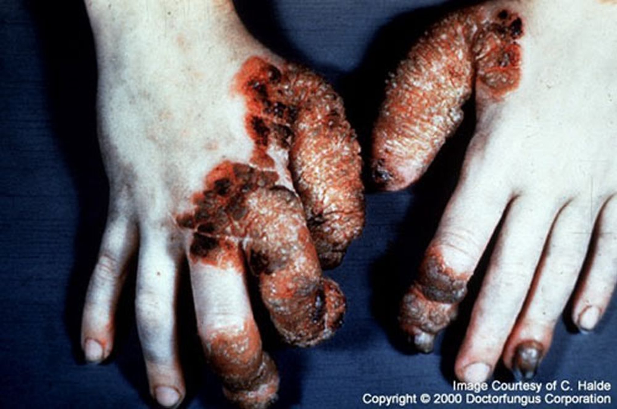 Chronic Mucocutaneous Candidiasis