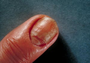 Infección de uñas (candidiasis)