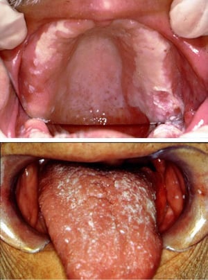 Candidiasis bucal (candidiasis de la boca) (debajo de las dentaduras postizas y sobre la lengua)