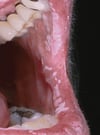 Candidiasis oral