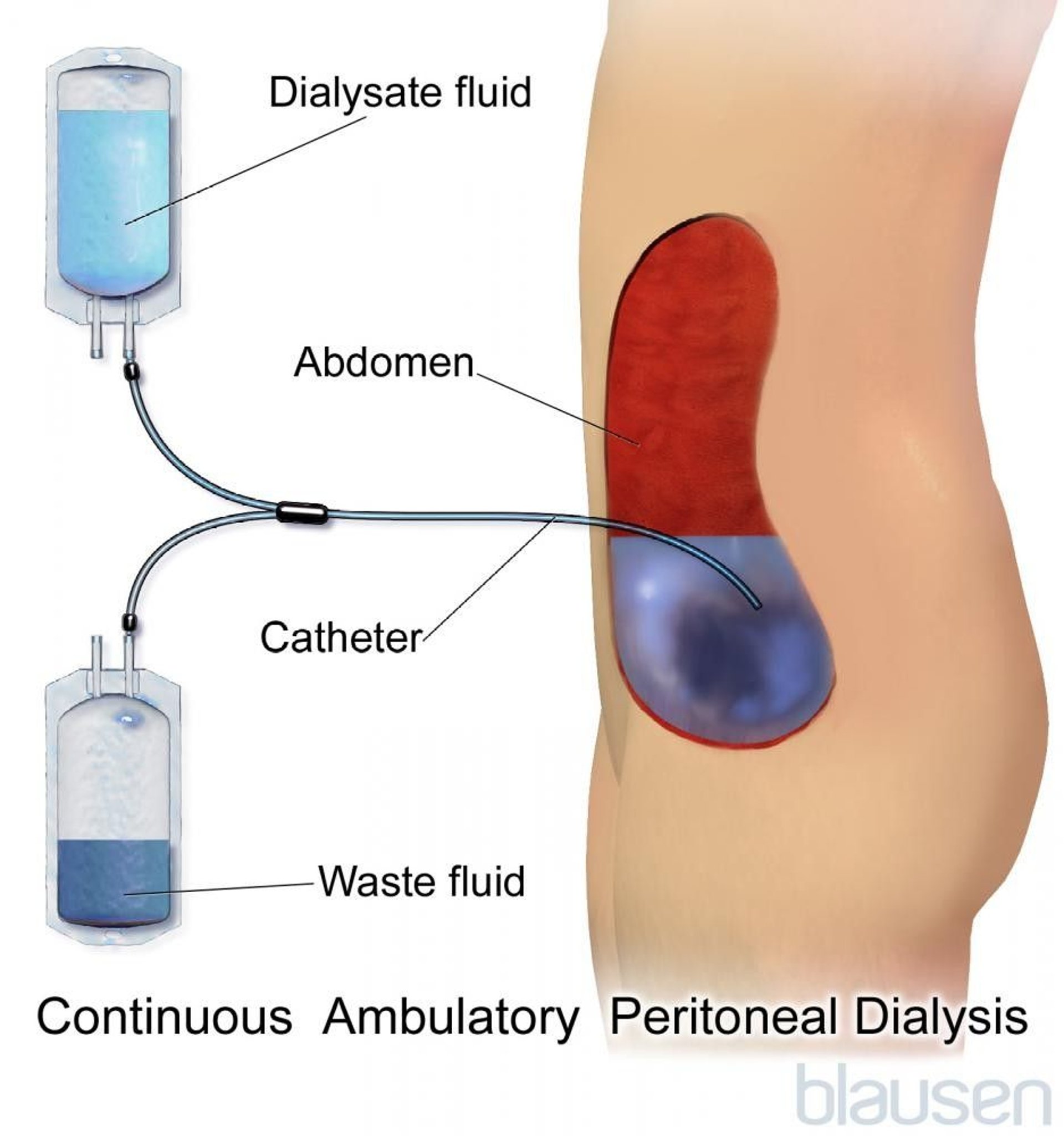 Continuous Ambulatory Peritoneal Dialysis