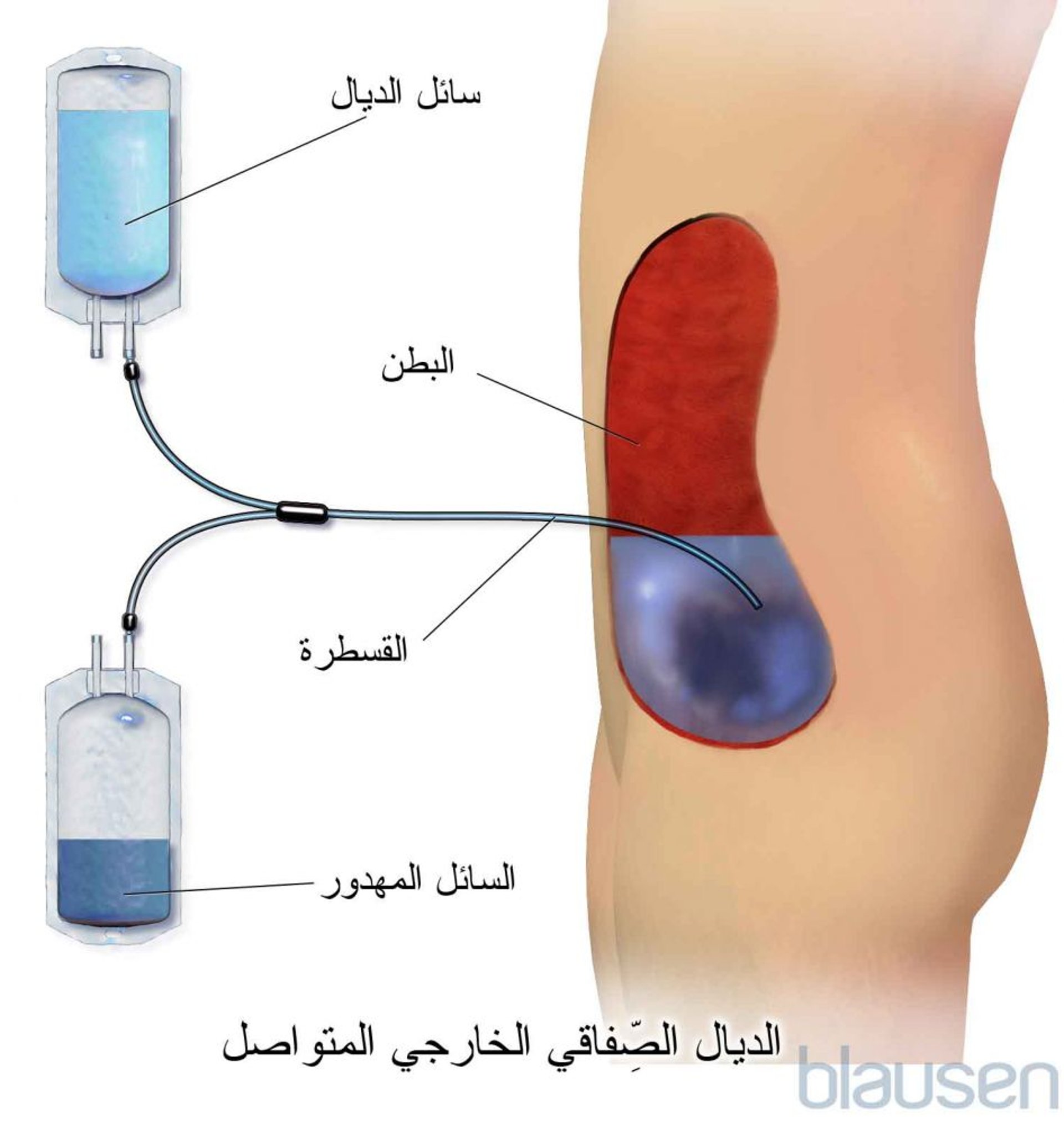 الديال الصفاقي المتنقل المستمر