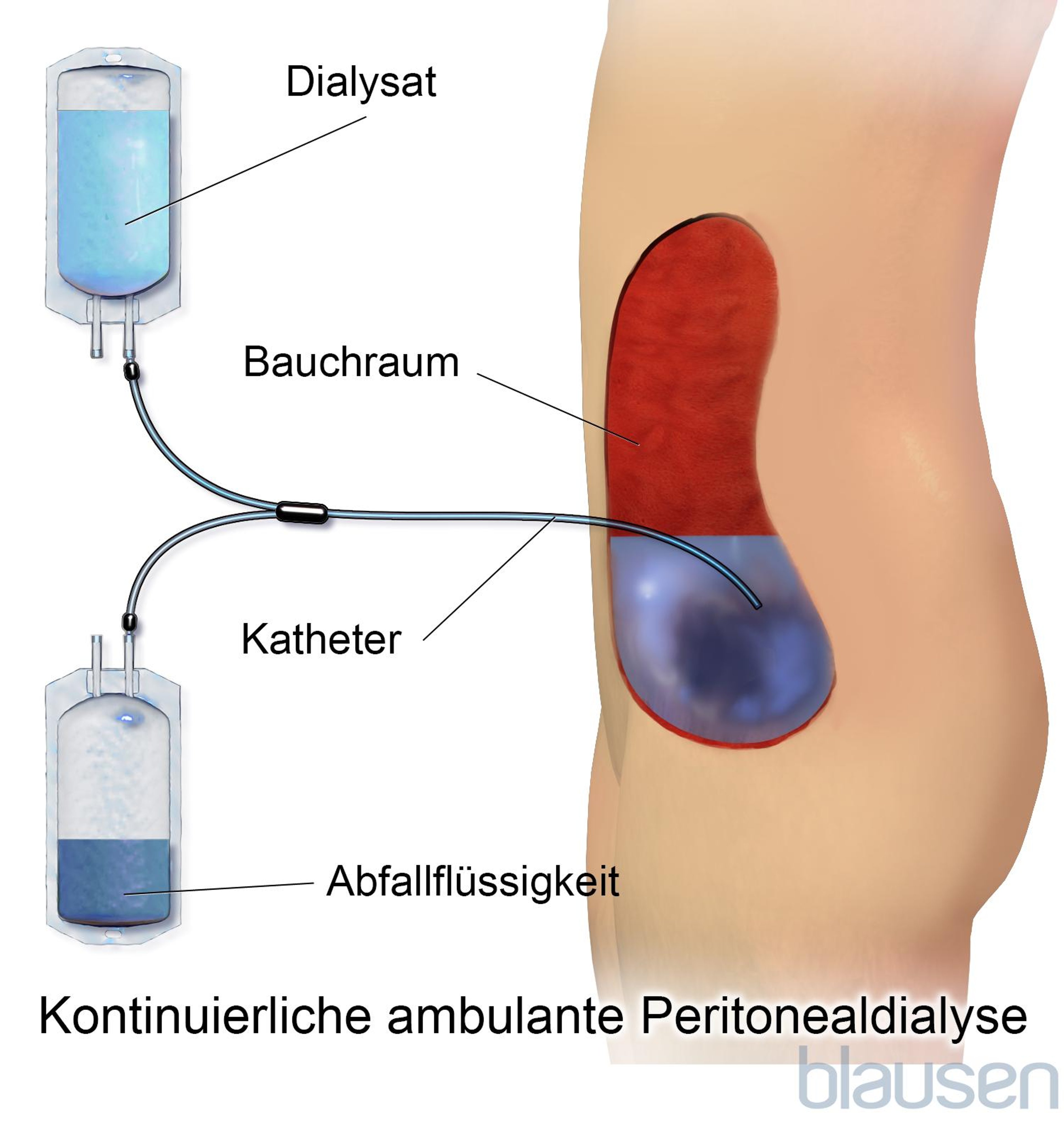 Kontinuierliche ambulante Peritonealdialyse