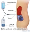 Diálisis peritoneal ambulatoria continua