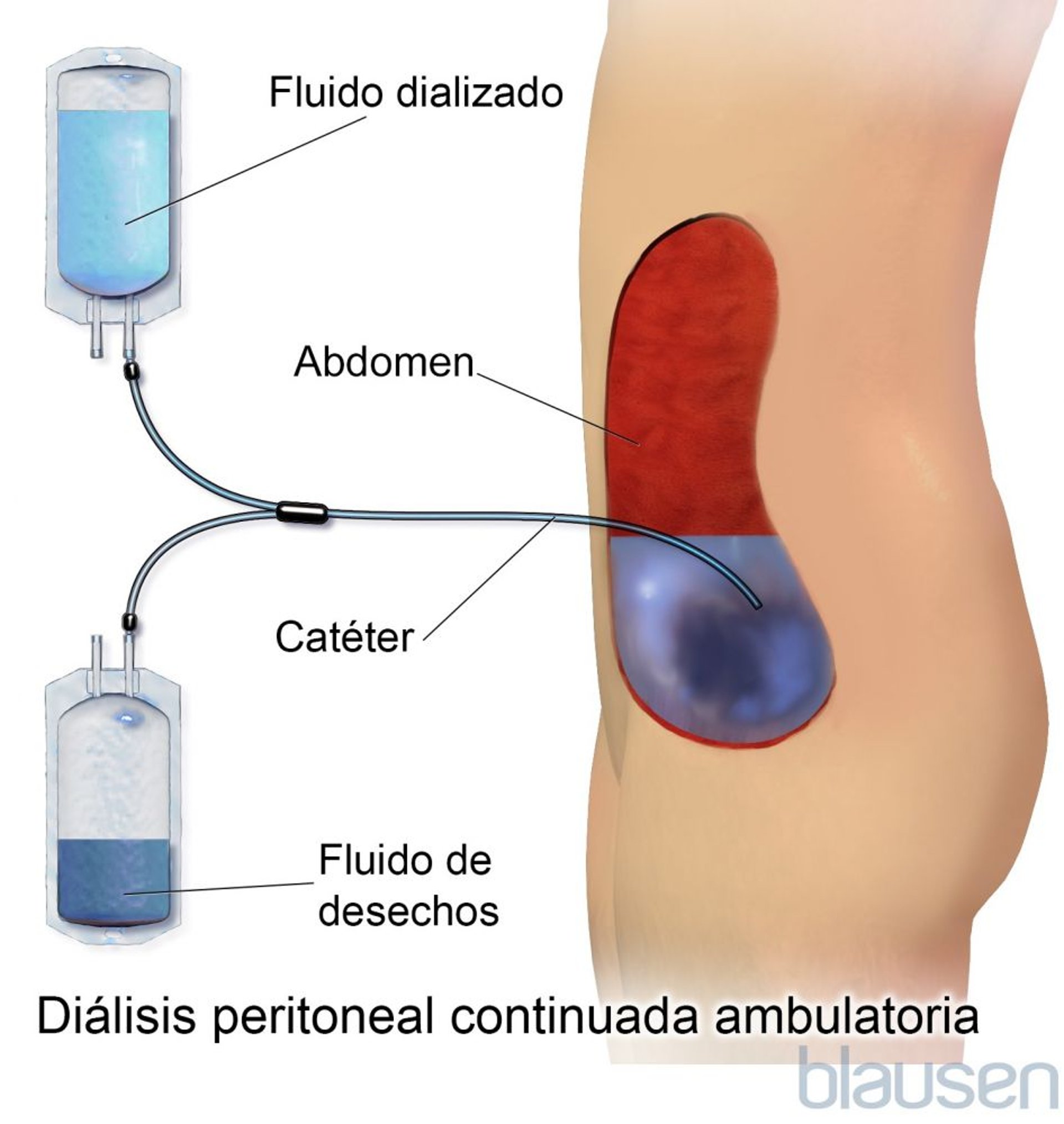 Diálisis peritoneal ambulatoria continua
