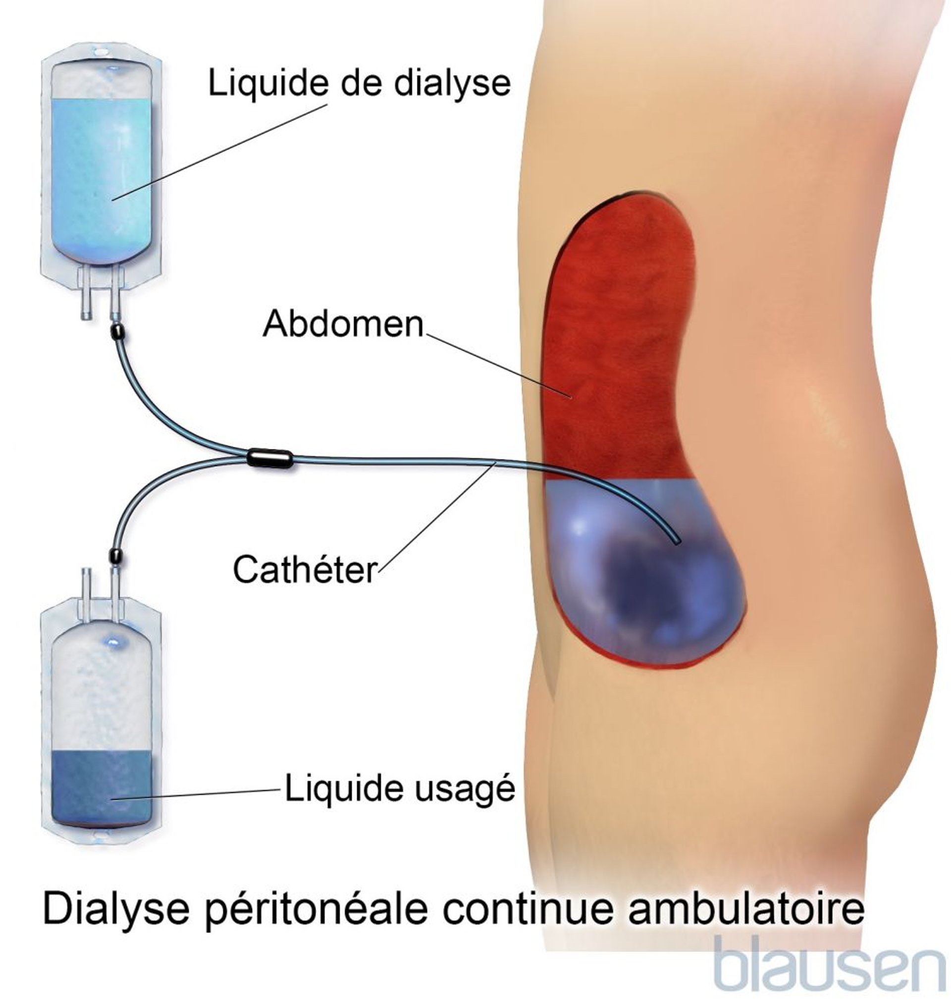Dialyse péritonéale continue ambulatoire