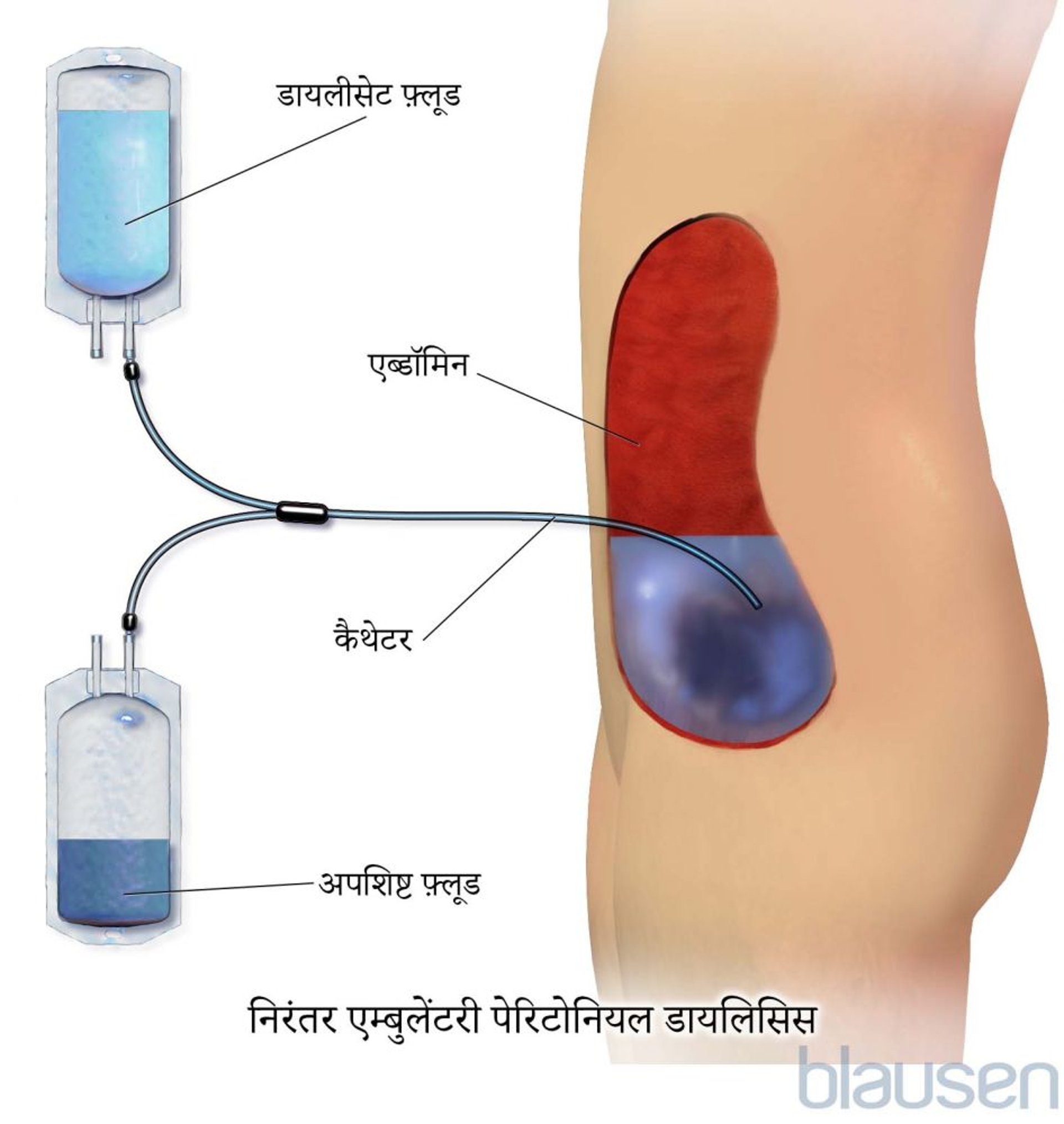 निरंतर एम्बुलेंट पेरिटोनियल डायलिसिस