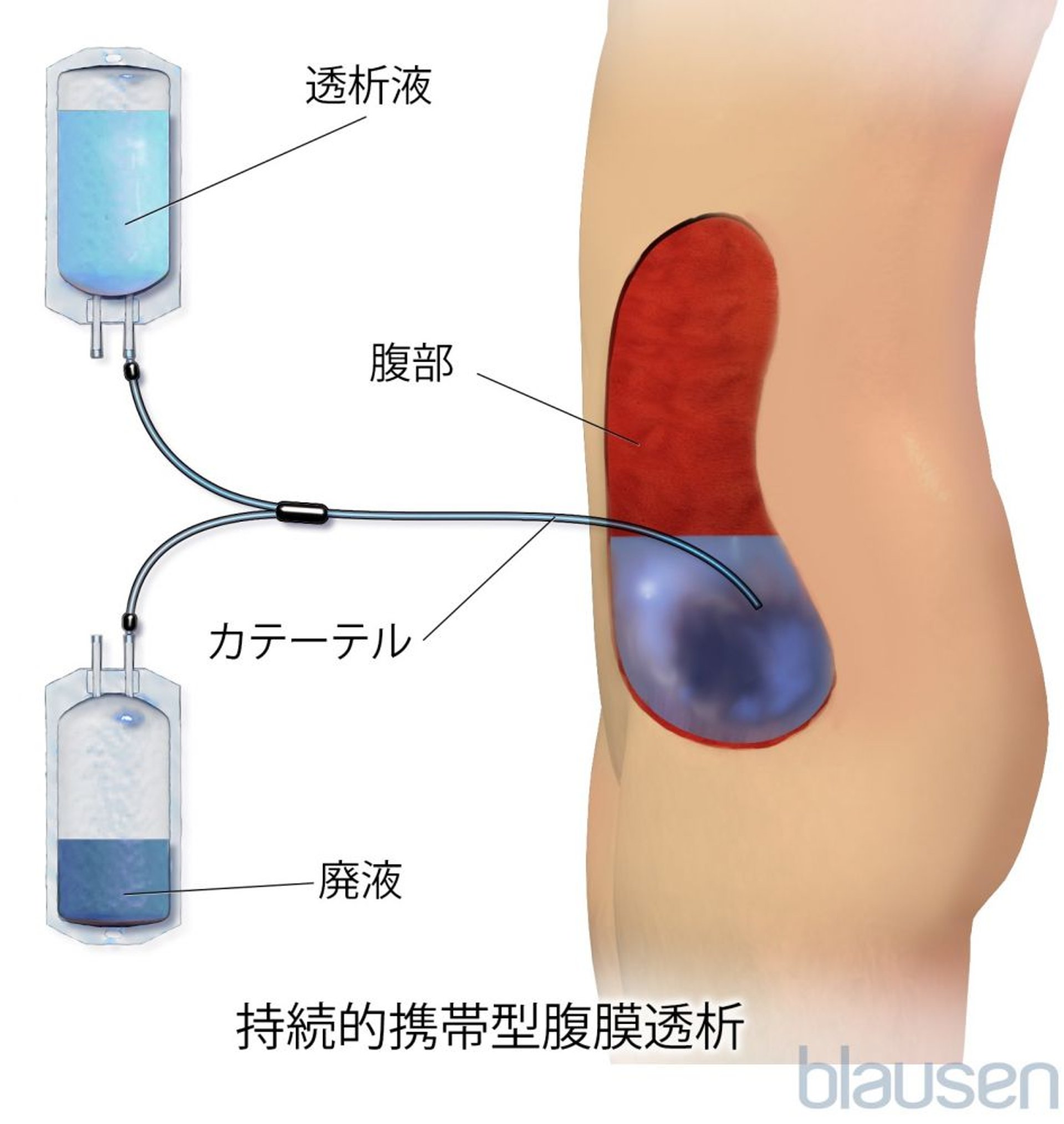 連続携行式腹膜透析