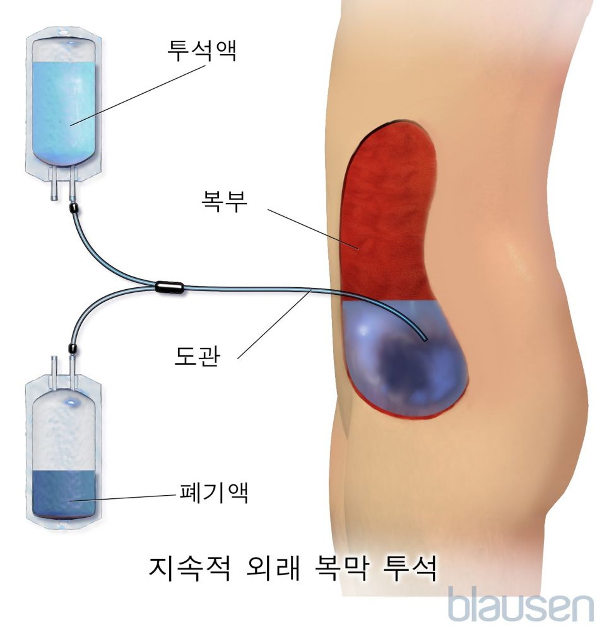 지속적 외래 복막 투석