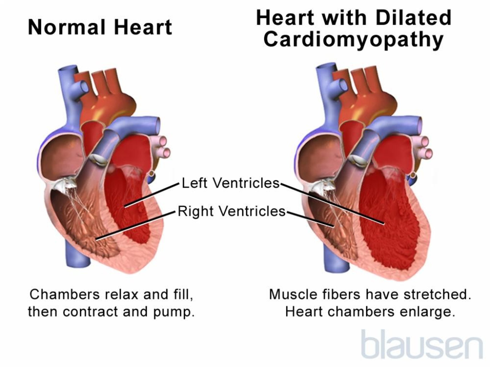 Dilated Cardiomyopathy