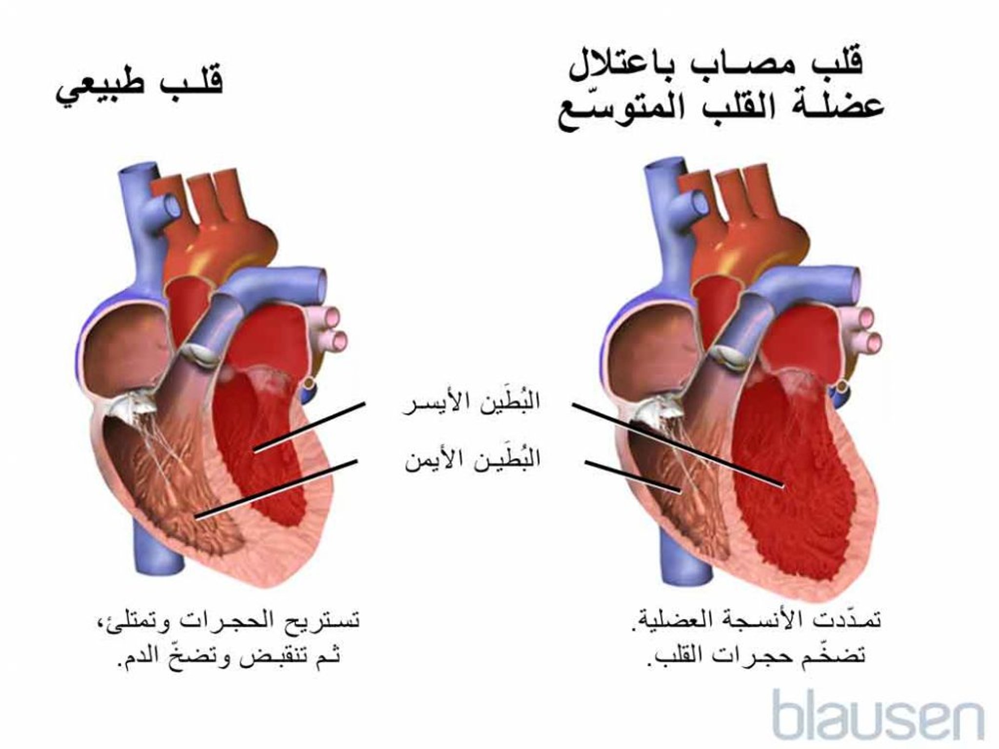اعتلال عضلة القلب التوسعي