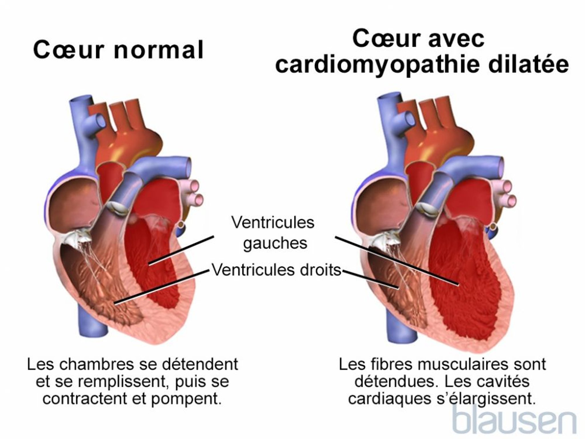 Cardiomyopathie dilatée
