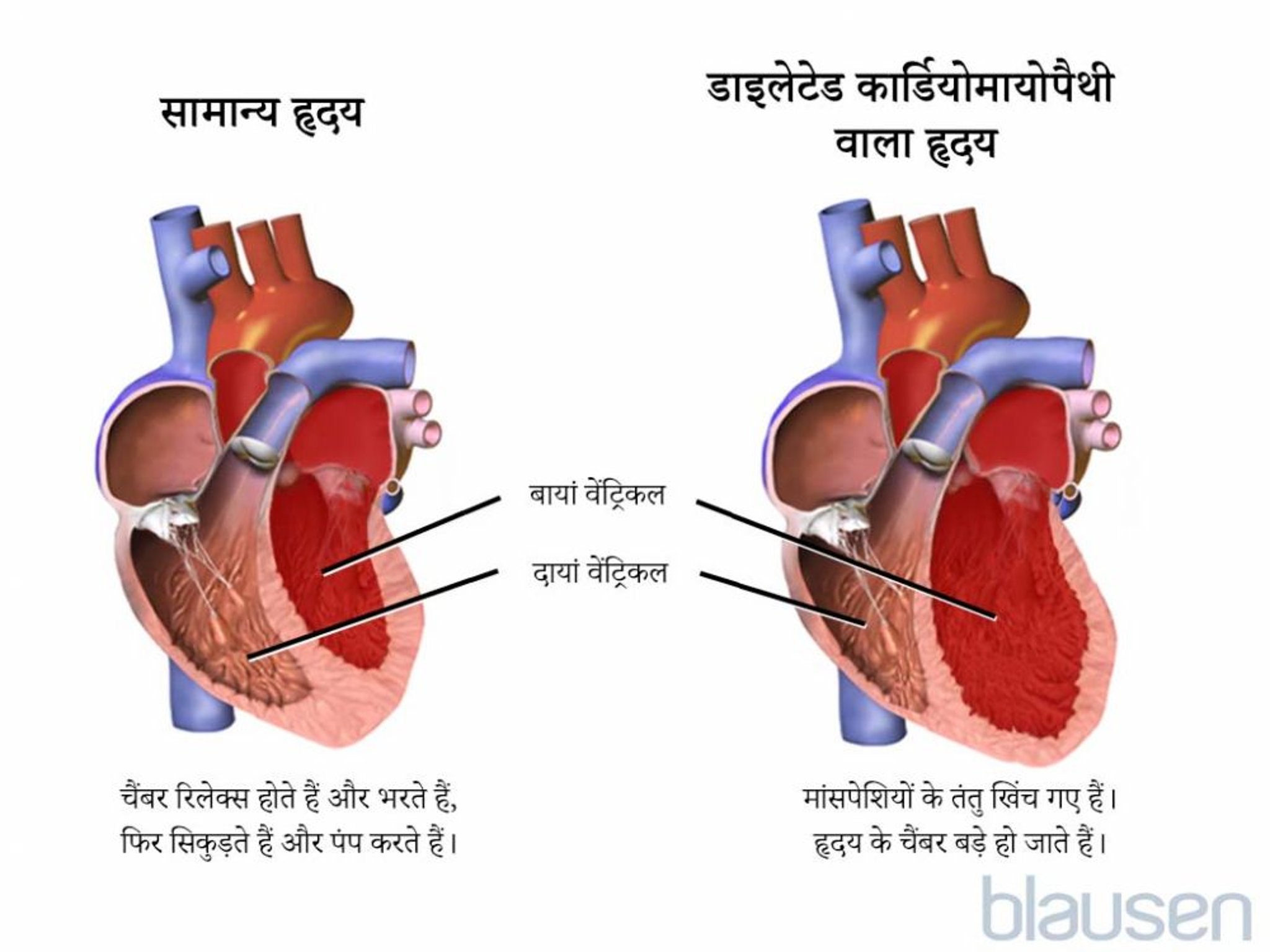 डाइलेटेड कार्डियोमायोपैथी