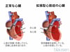 拡張型心筋症