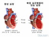 확장성 심근병증