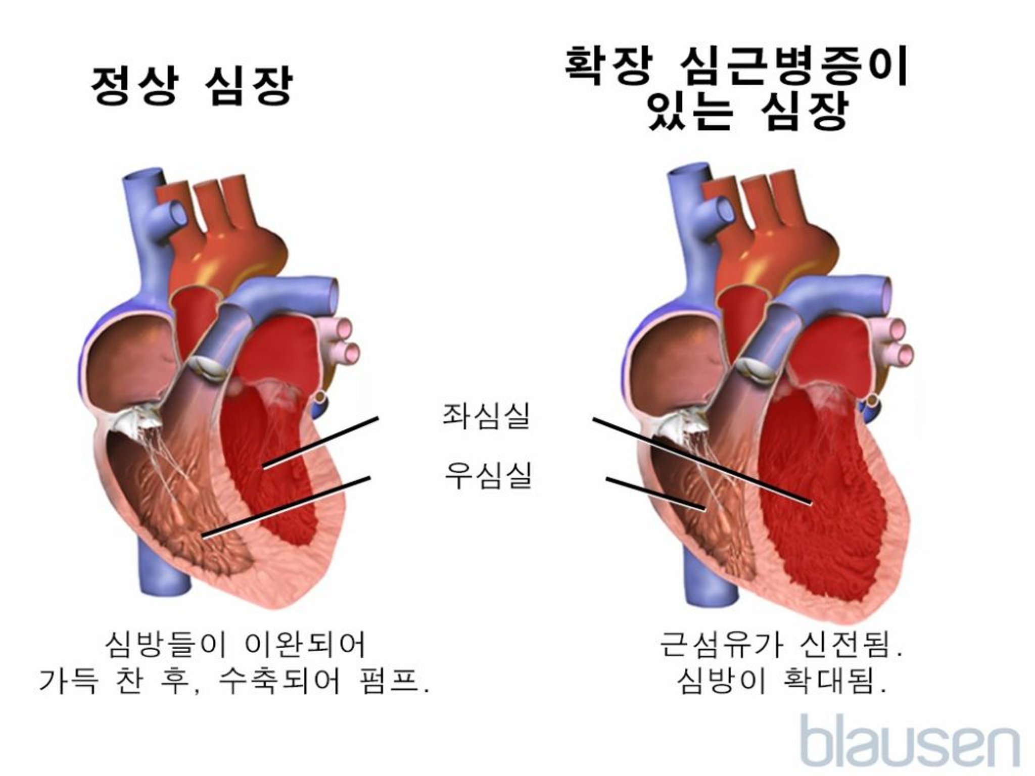 확장성 심근병증