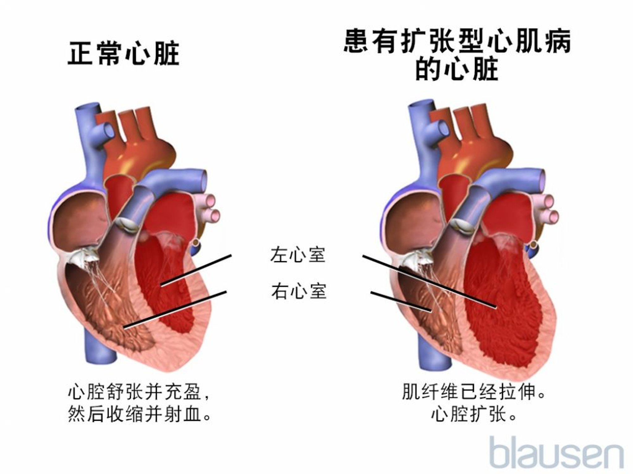 扩张型心肌病