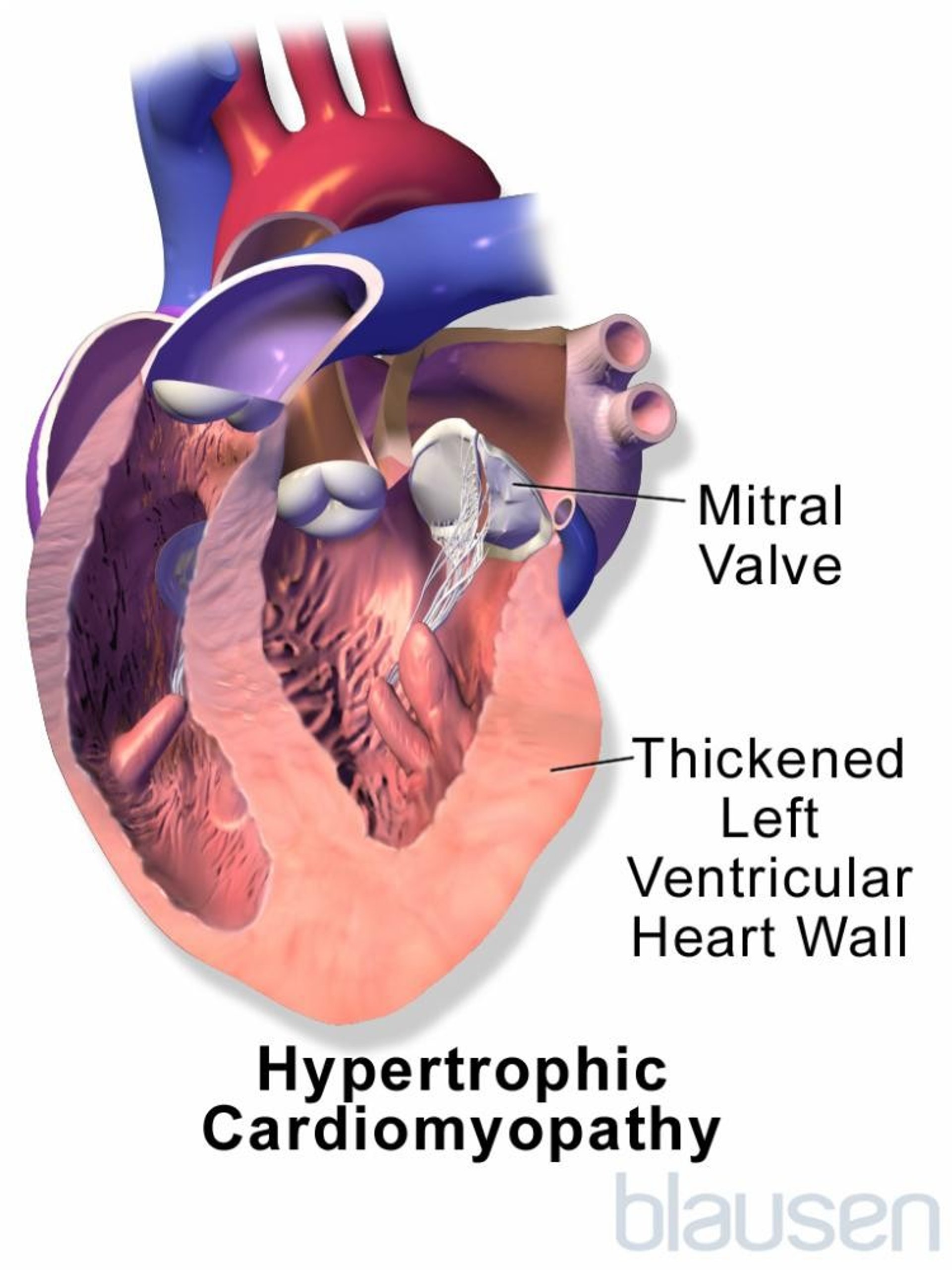 Hypertrophic Cardiomyopathy