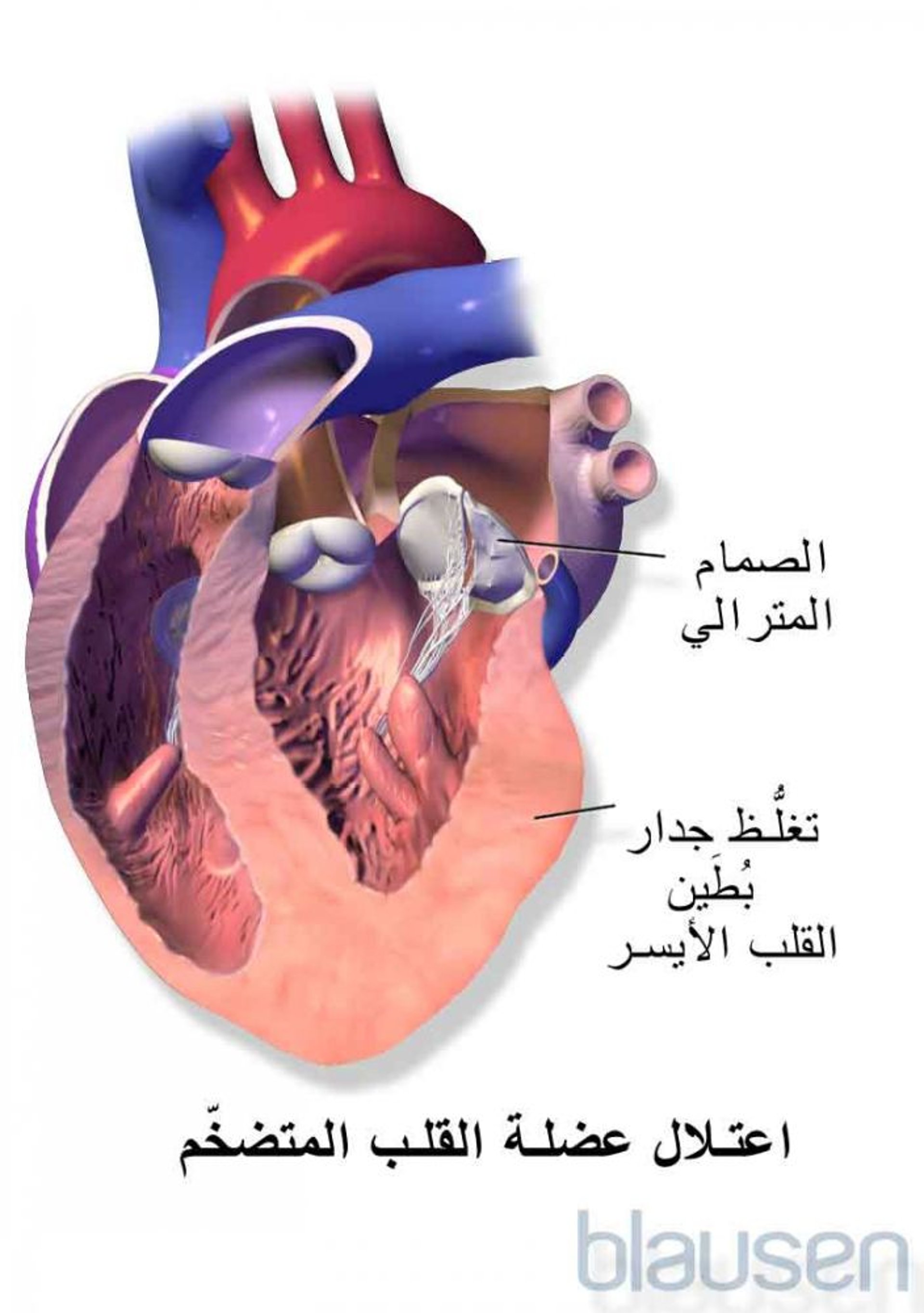 اعتلال عضلة القلب الضخامي