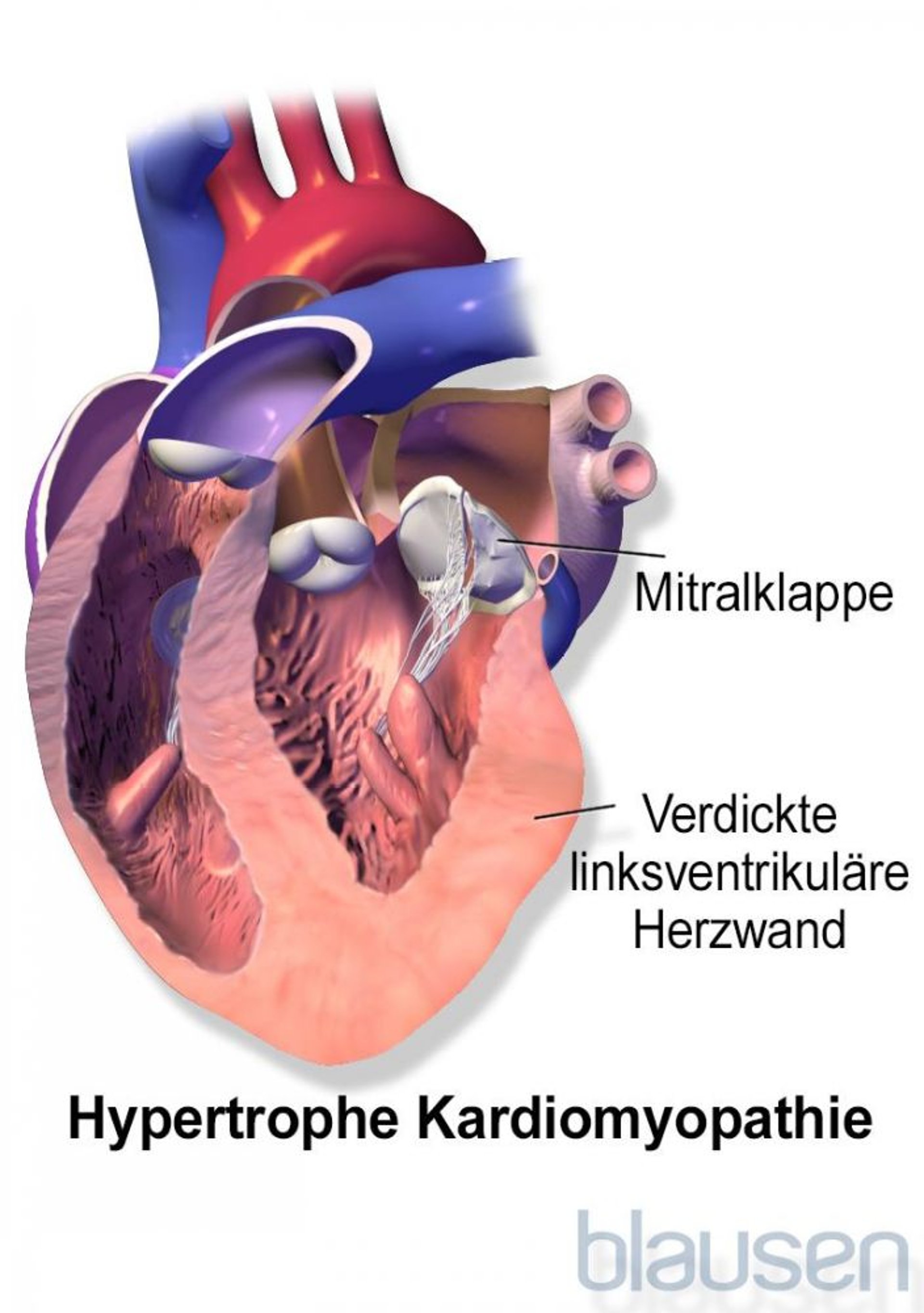 Hypertrophe Kardiomyopathie