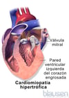 Miocardiopatía hipertrófica