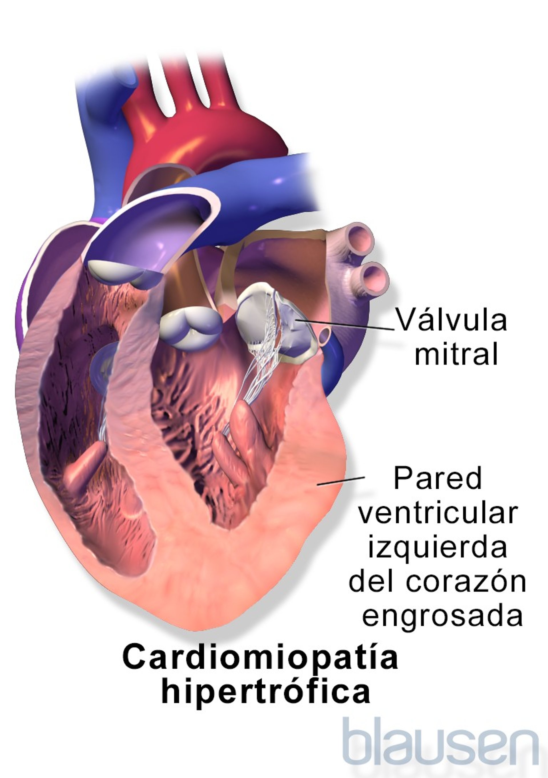 Miocardiopatía hipertrófica